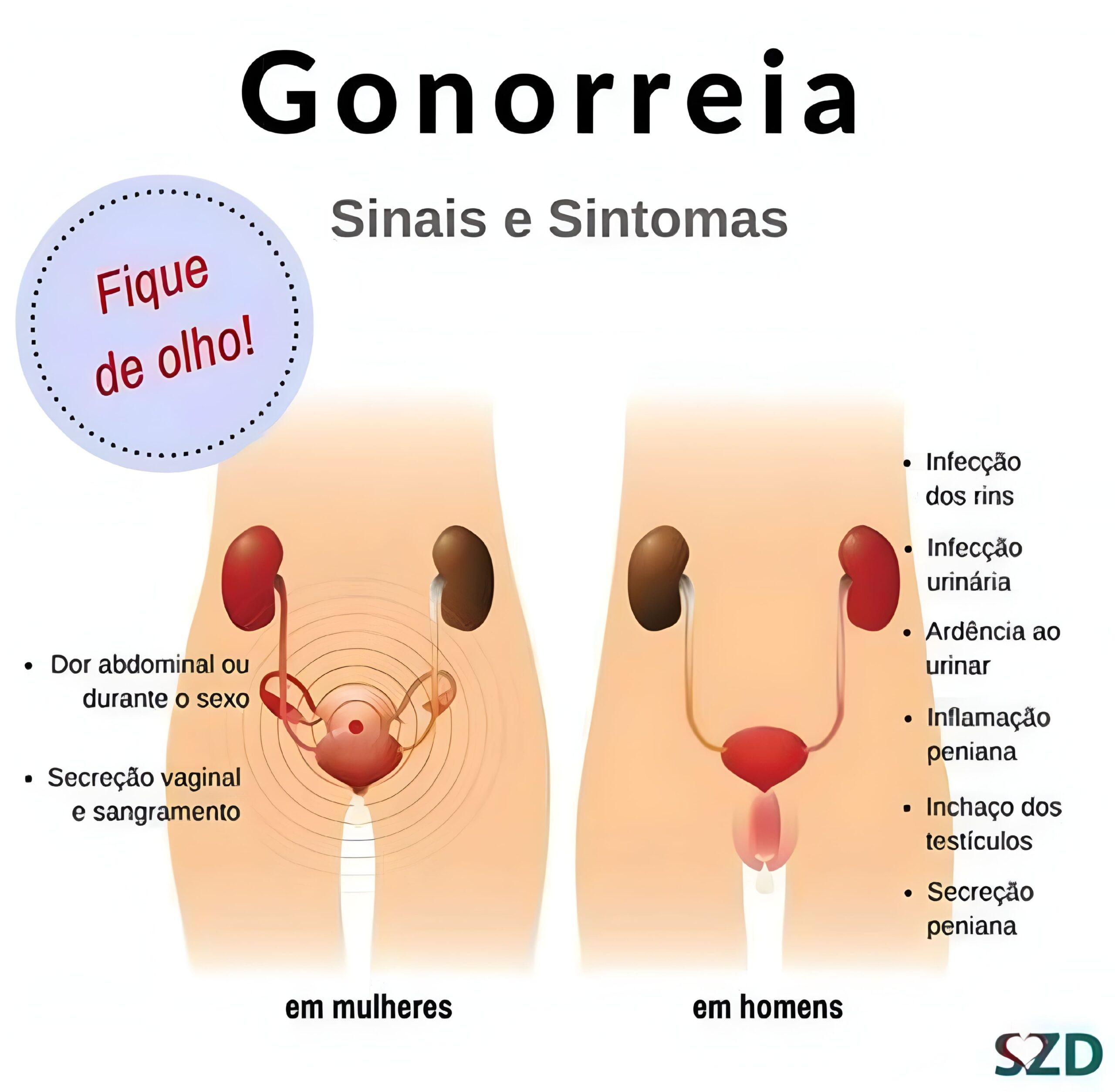 Gonorreia - sinais e sintomas