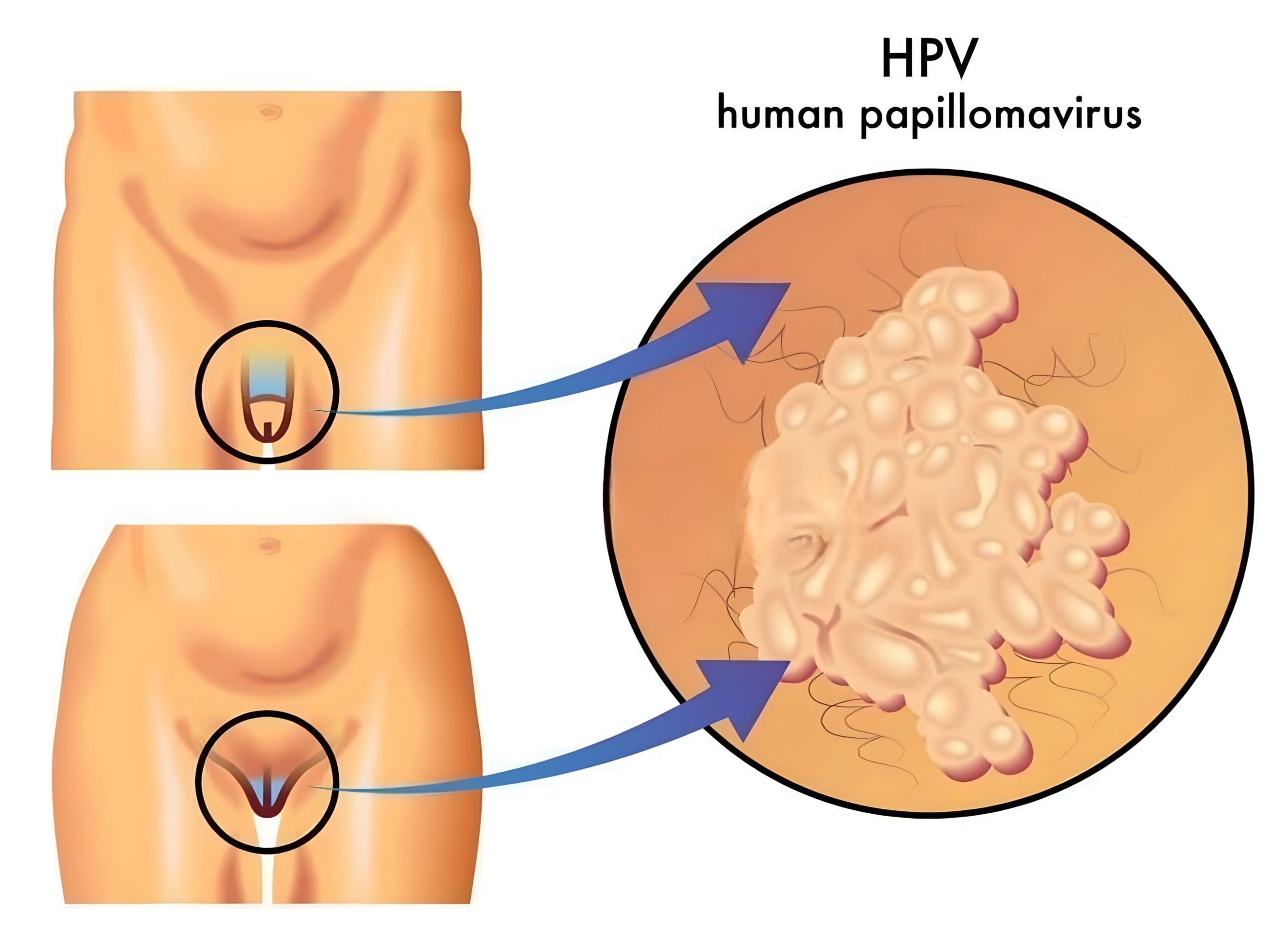 HPV - ilustração